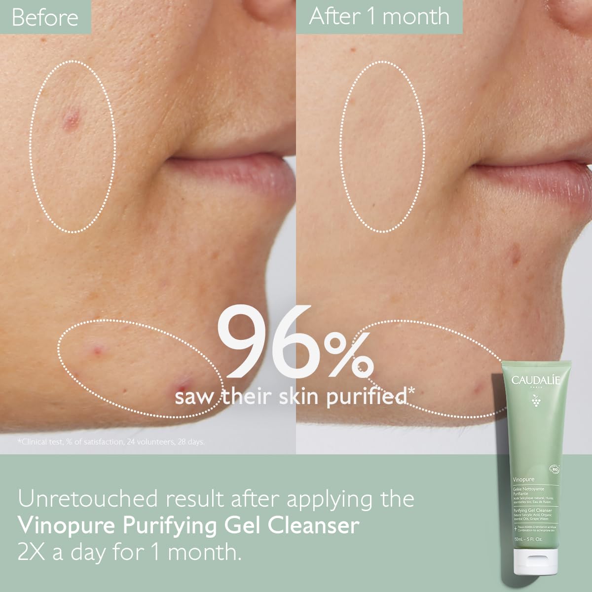 Refresh and Purify Your Skin with Vinopure Purifying Gel Cleanser - 150 Ml