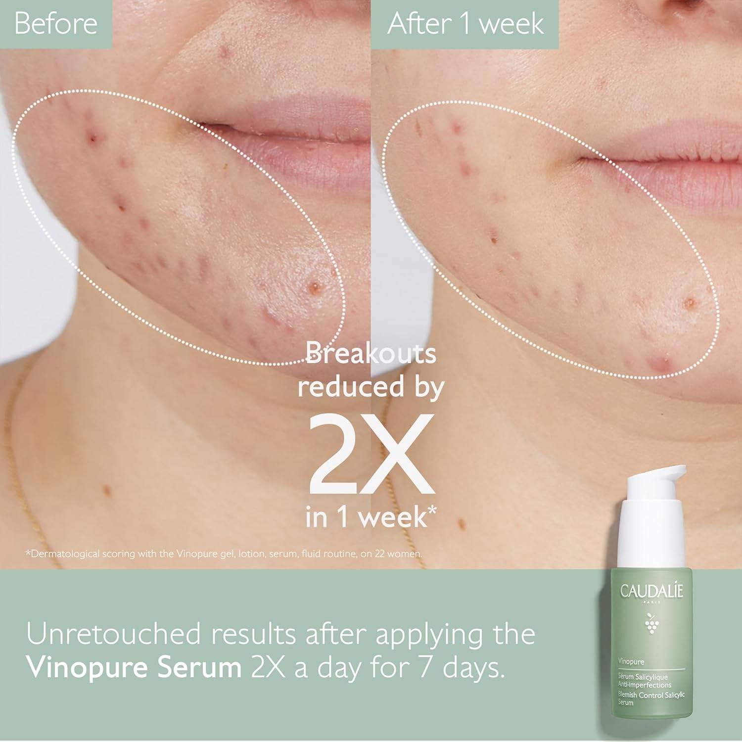 Transform Your Skin with Vinopure Natural Salicylic Acid Pore Minimizing Serum - Includes 2 Travel Size Essentials!